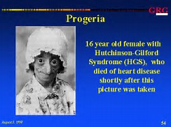 progeria 3